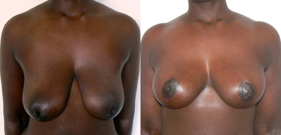 Breast UpLift & Reduction before and after photo by Dr. Foued Hamza in London, UK