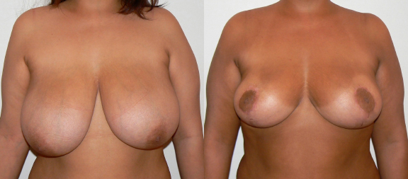 Breast UpLift & Reduction before and after photo by Dr. Foued Hamza in London, UK
