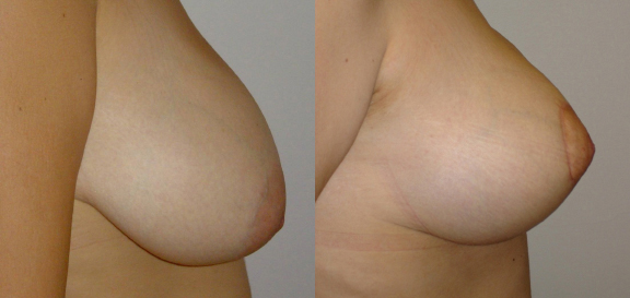 Breast UpLift & Reduction before and after photo by Dr. Foued Hamza in London, UK