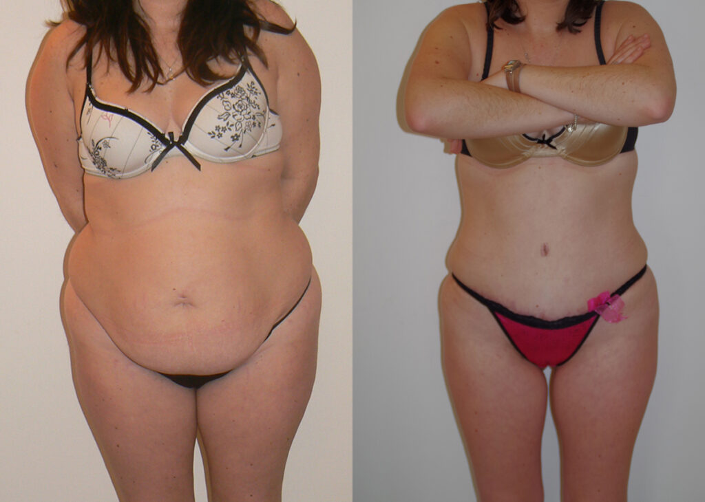 Tummy Tuck before and after photo by Dr. Foued Hamza in London, UK